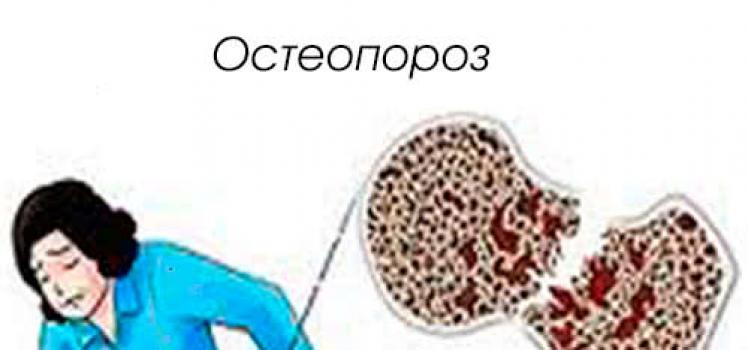 Остеопороз суставов Бывает ли температура при остеопорозе